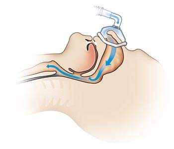 With CPAP: open airway illustration