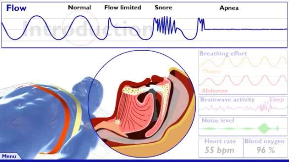 Chart on what to look for in the flow of breathing: normal (regular waves) vs. sleep apnea (burst and then flat line)