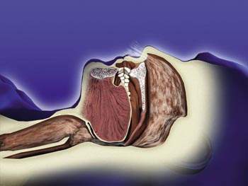 Airway partially closed